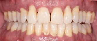 Catarrhal gingivitis