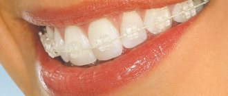 Ceramic braces