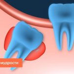 Wisdom tooth cyst in pictures