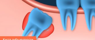 Wisdom tooth cyst in pictures