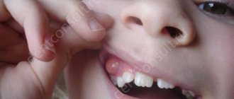 Tooth cyst in a child