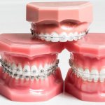 Classification of braces