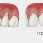 Gum coagulation before and after.jpg