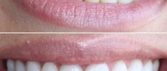 когда рекомендуется использовать Crest Whitestrips