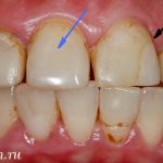 composite fillings on front teeth