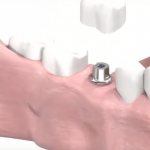 Crown on an implant