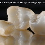 коронки из диоксида циркония