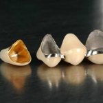 metal-ceramic crowns