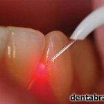 Laser dentistry