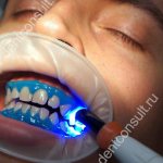 laser whitening