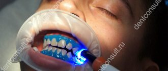 laser whitening