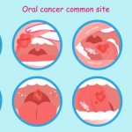 treatment of allergic stomatitis