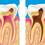 Treatment and causes of caries under fillings