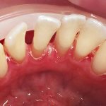 Treatment of periodontal disease