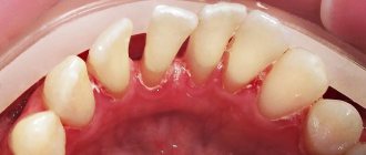 Treatment of periodontal disease