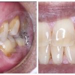 treatment of cervical caries