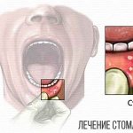 Treatment of stomatitis with Viferon