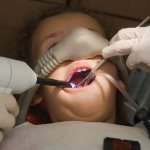 Dental treatment for children under general anesthesia