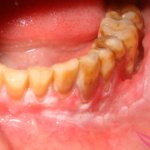 leukoplakia