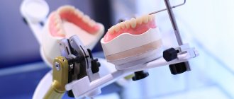 Materials for the manufacture of fixed dentures