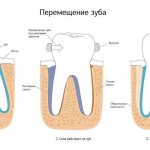 Механизм коррекции прикуса при помощи брекет-систем