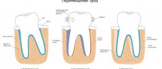 The mechanism of bite correction using braces