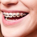 metal braces