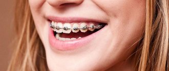 metal braces