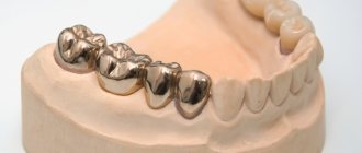 Metal dental crowns