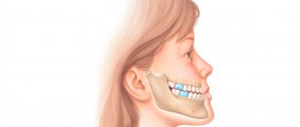 Mesial bite