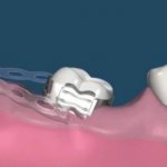 Microimplants in orthodontics prices