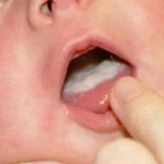 Молочница во рту у ребёнка