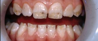 Некариозные поражения тканей зуба: гипоплазия молочных зубов