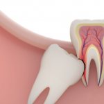 need for wisdom tooth removal