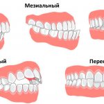 Неправильный прикус