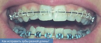неровные передние зубы.jpg
