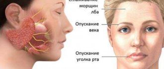 Facial neuritis