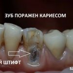 The lower canine under the filling is affected by caries. And you see the anchor pin. We will delete it. Doctor - Sergey Samsakov, CERECON dental clinic 