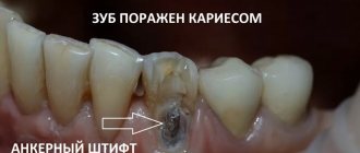 Нижний клык под пломбой поражен кариесом. И вы видите анкерный штифт. Его будем удалять. Доктор - Сергей Самсаков, стоматологическая клиника CERECON