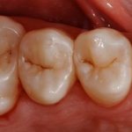 occlusal plane of teeth