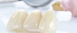 Description, types and purpose of temporary dentures