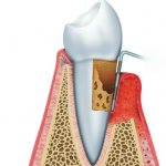 Determination of periodontal indices in dentistry