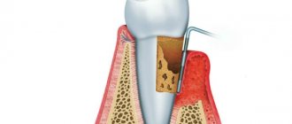 Determination of periodontal indices in dentistry