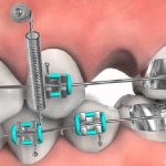 Ортодонтические микроимпланты
