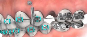 Orthodontic microimplants