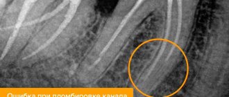 Error when filling a canal on x-ray