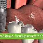 осложнения после имплантации зубов