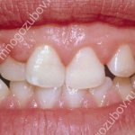 Main symptoms of gum hyperplasia