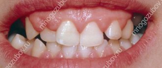 Main symptoms of gum hyperplasia