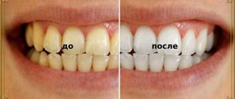 whitening with foil: before and after